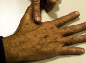 Brasil tem 700 mil novos casos de câncer: 40% podem ser evitados