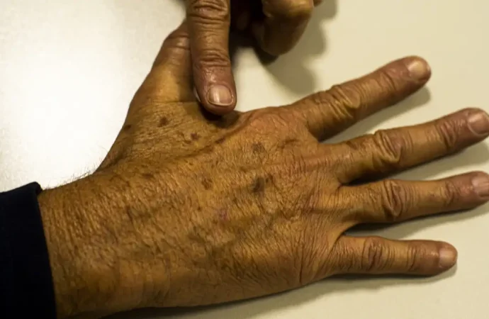 Brasil tem 700 mil novos casos de câncer: 40% podem ser evitados