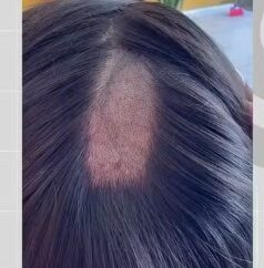 Mulher denuncia falha em exame toxicológico para CNH após ter parte do cabelo raspada